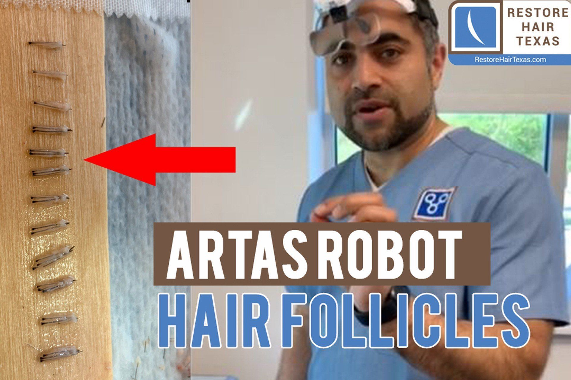 what-do-follicle-look-like-after-the-artas-robot-removes-them